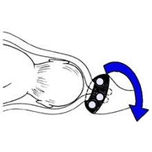 Cerclage pesszárium 65-17-32