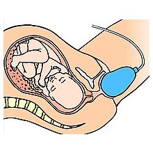 EPI • NO®  Delphine