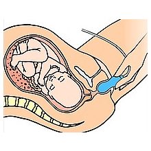 EPI • NO®  Delphine plusz 