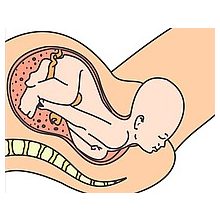 EPI • NO®  Delphine plusz 